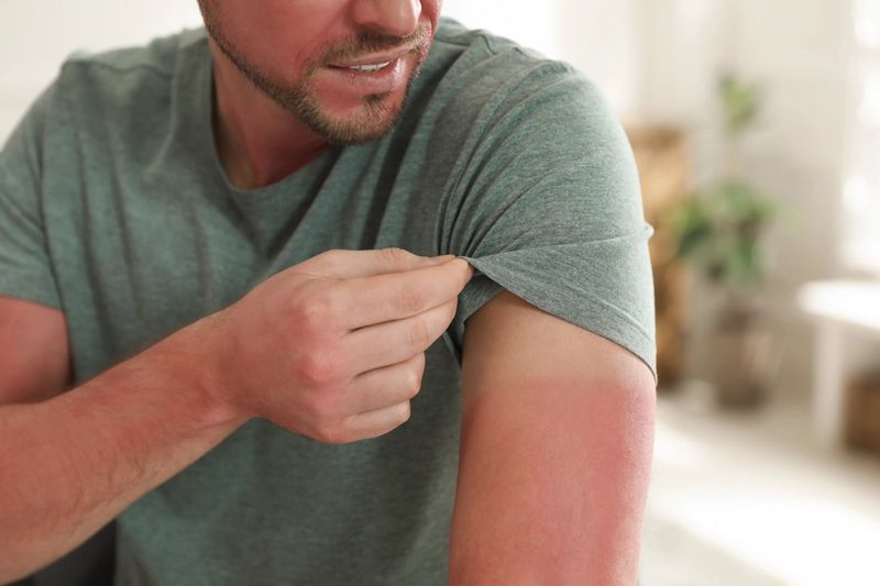 Soothe Sunburned Skin