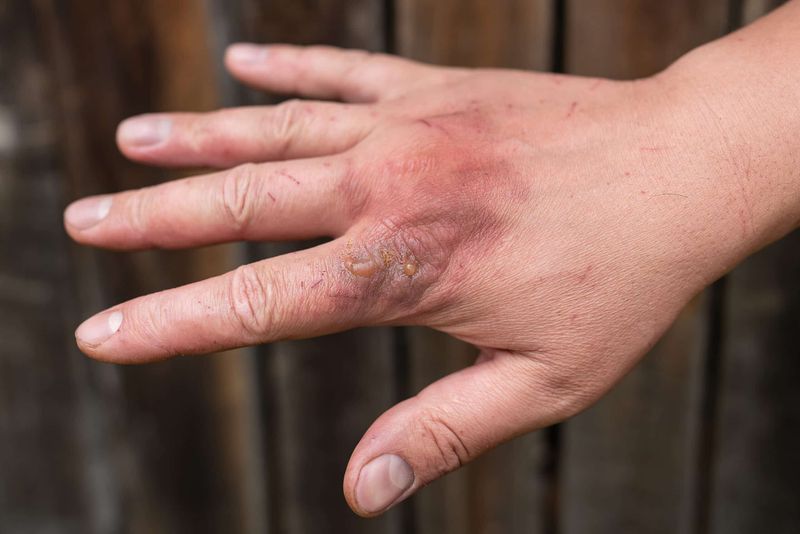 When to seek medical advice about the sting