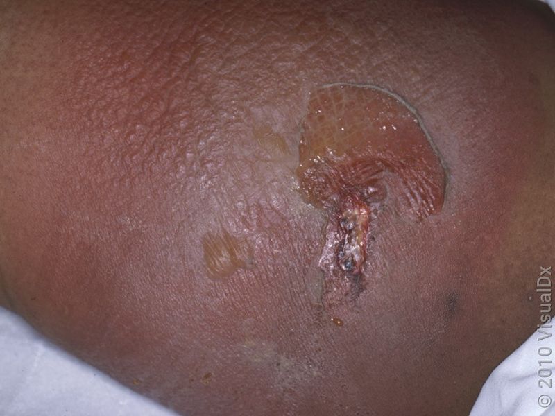 Symptoms can intensify after a small initial mark