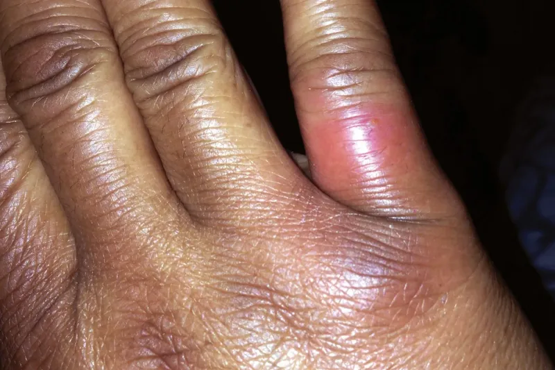 Move away, wash the suspected bite, and call for guidance