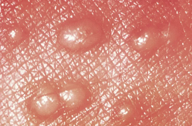 What the next-day white pustule means