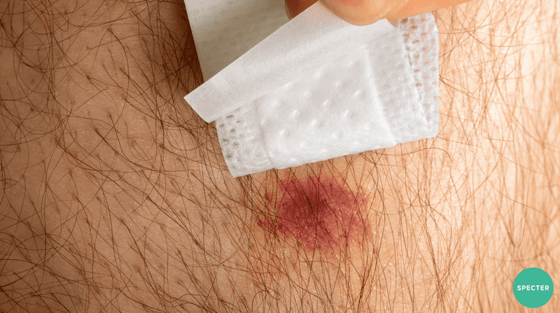 Use simple measures for pain and swelling