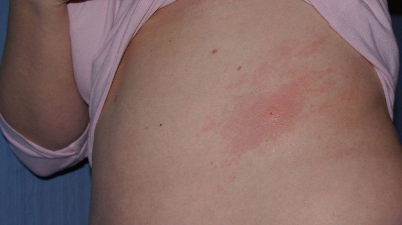 Severe sting reactions require emergency care