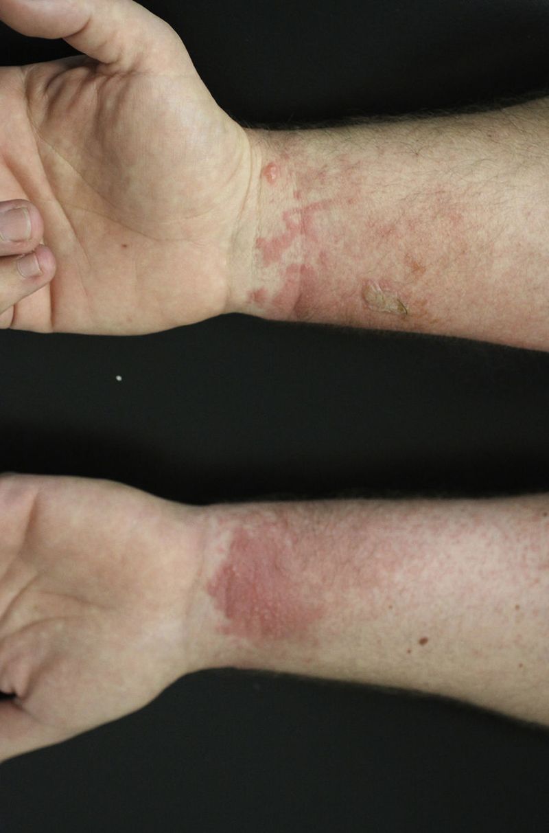 Plantain is not guaranteed to be gentle on skin