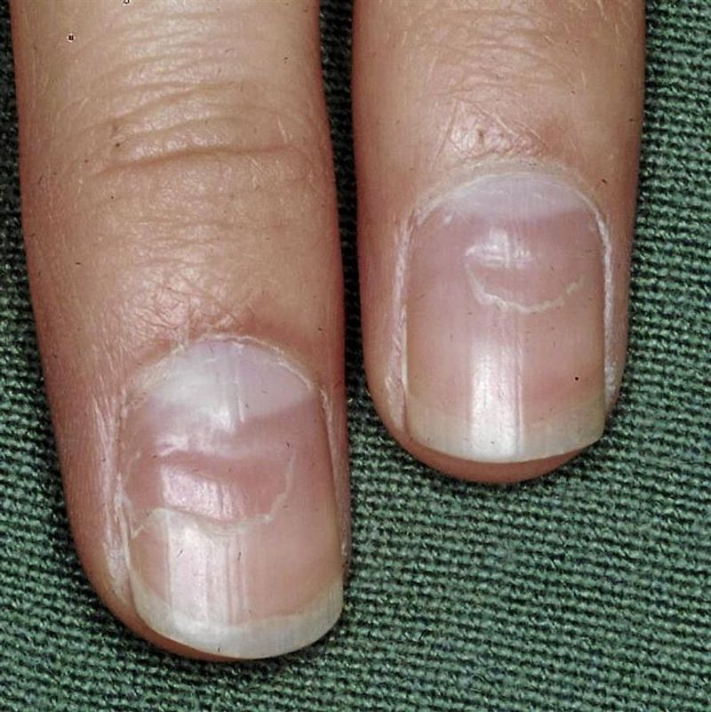 Spoon-Shaped Nails Reveal Serious Nutritional Deficits
