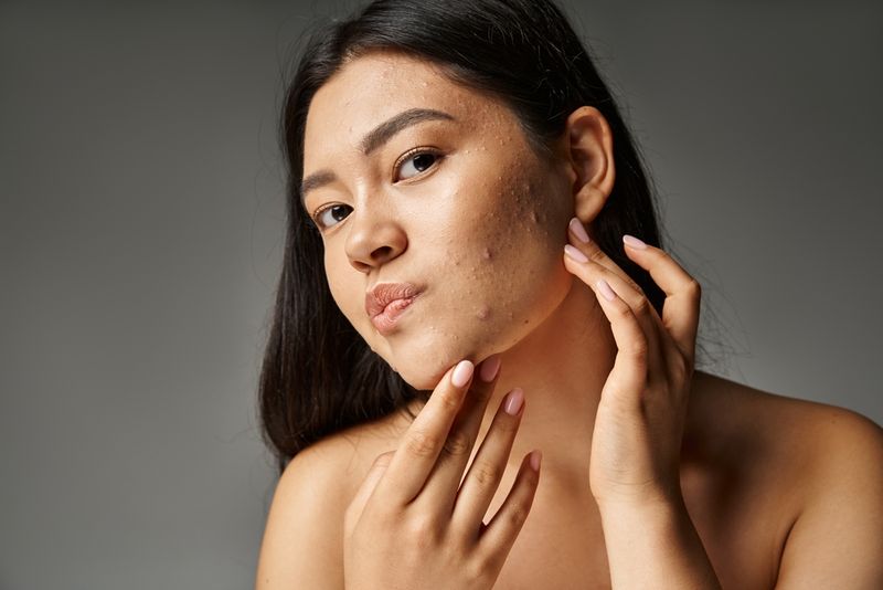 Acne Means Poor Hygiene