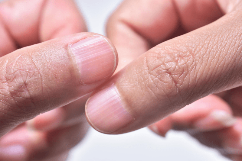 Horizontal Ridges Reflect Major Health Stresses