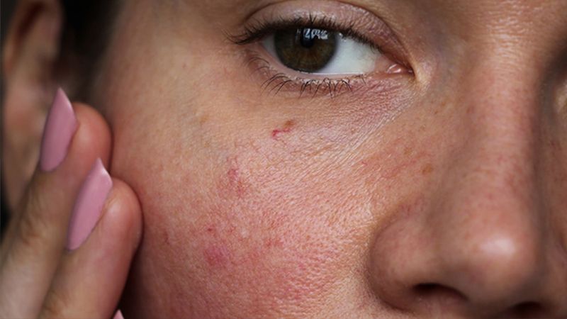Over-Exfoliating Your Skin