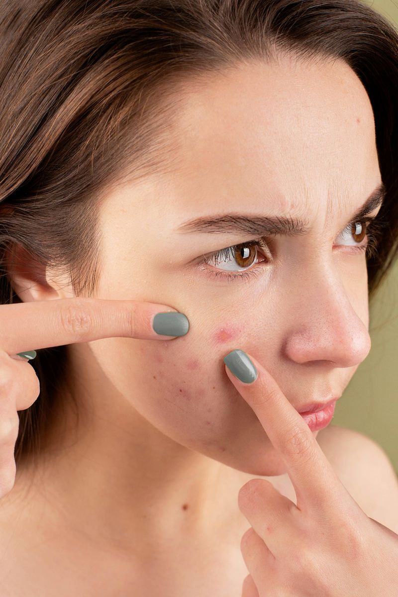 Aggressive Acne Treatment