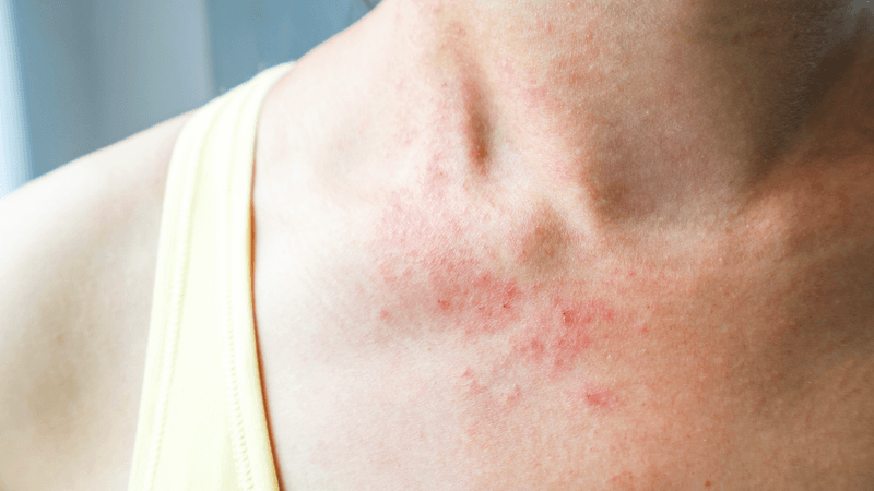 Skin Rashes That Come and Go