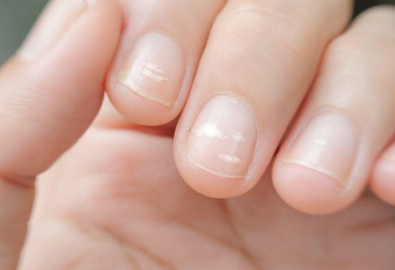Pale or White Nail Beds Signal Iron Deficiency