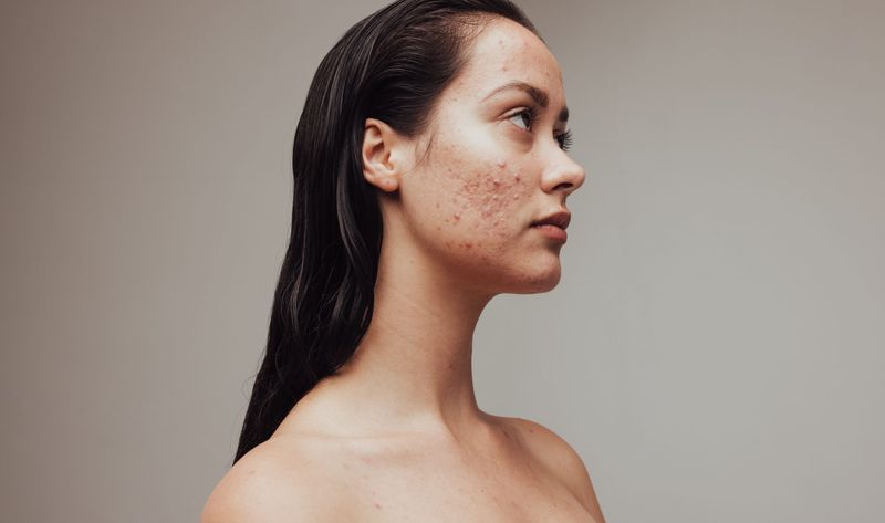 Skin Breakouts or Rashes