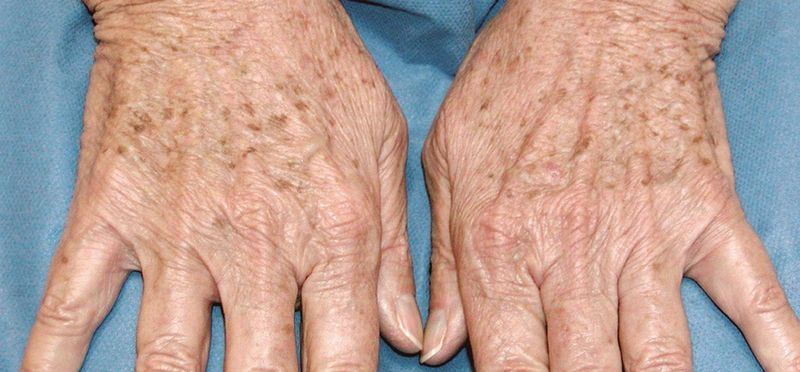 Sun Damage Surfaces as Spots