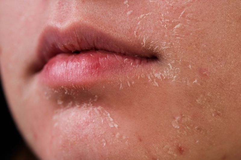Dry Skin and Lips