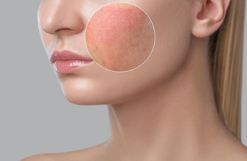 Skin Irritations