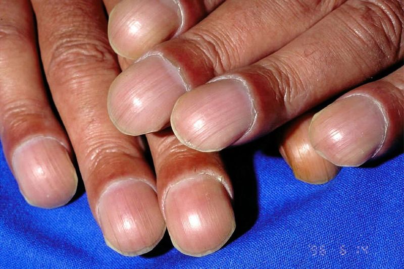 Clubbed Nails Point to Lung and Heart Disease