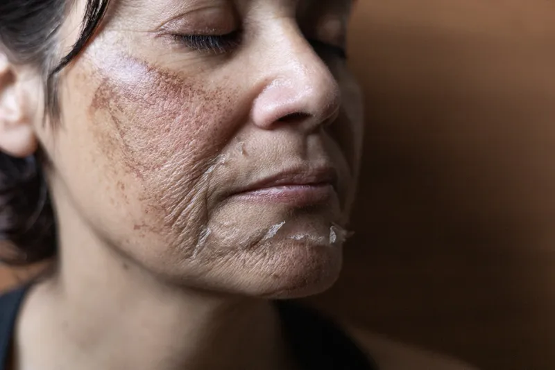 DIY Chemical Peels: At-Home Acid Disasters