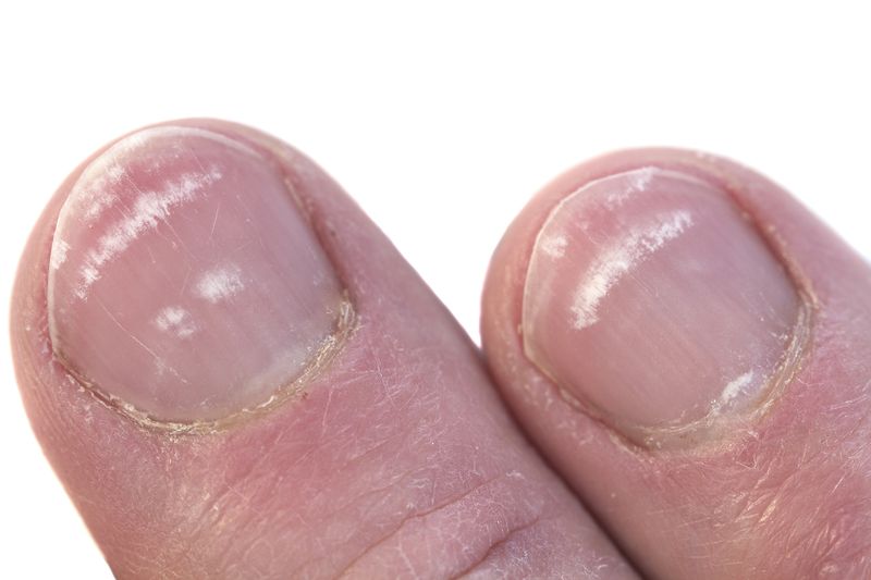 White Spots Indicate Zinc Deficiency or Trauma
