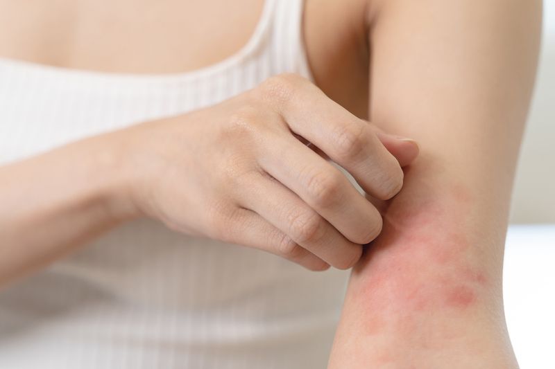 Recurring Skin Infections