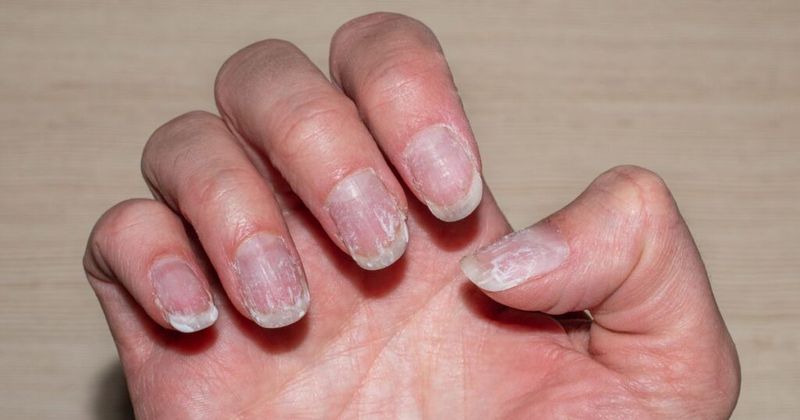 Brittle Nails Suggest Thyroid Disorders