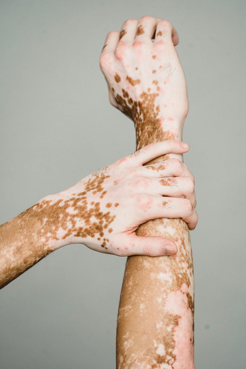 Autoimmune Conditions