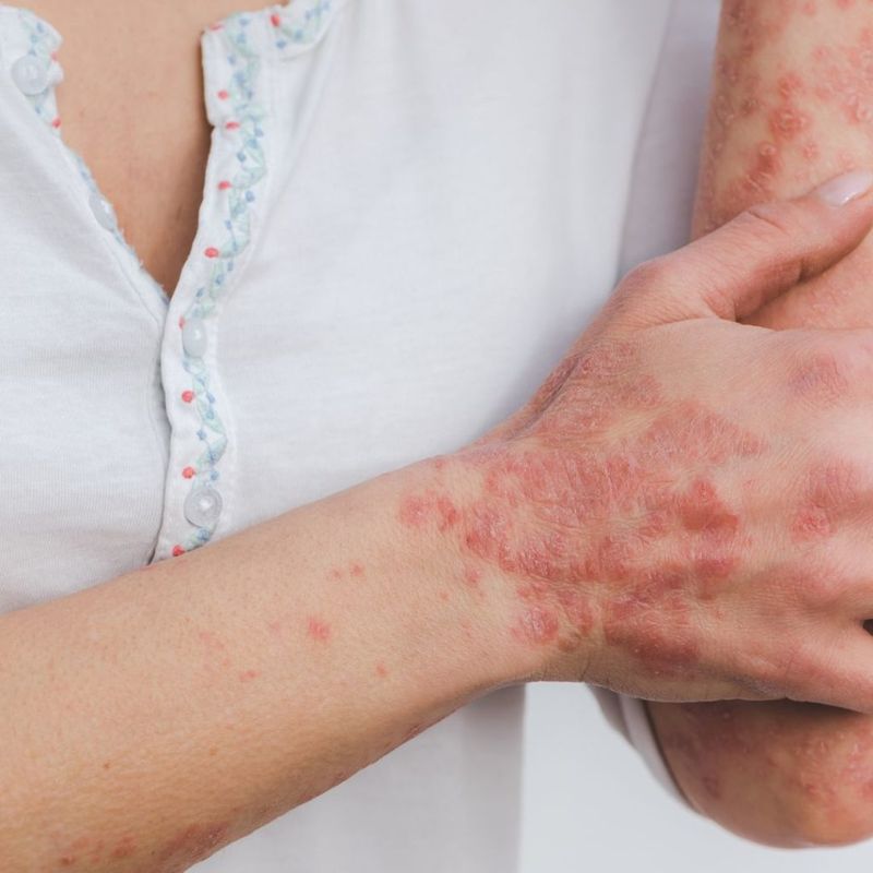 7. Skin Conditions Flare Up