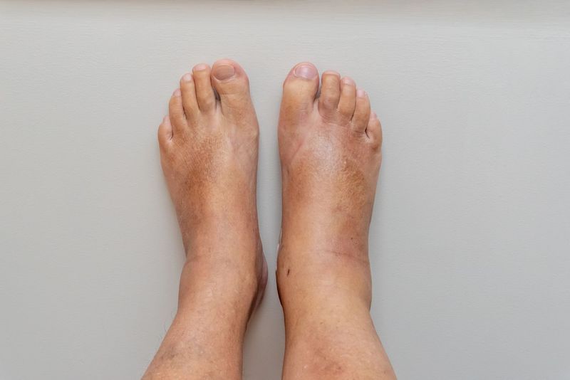 Swelling and Circulation Issues